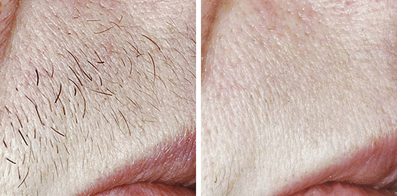 Hair Removal by electrolysis gallery. Weatherford, TX - Platinum  Electrolysis Permanent Hair Removal 817-800-5116